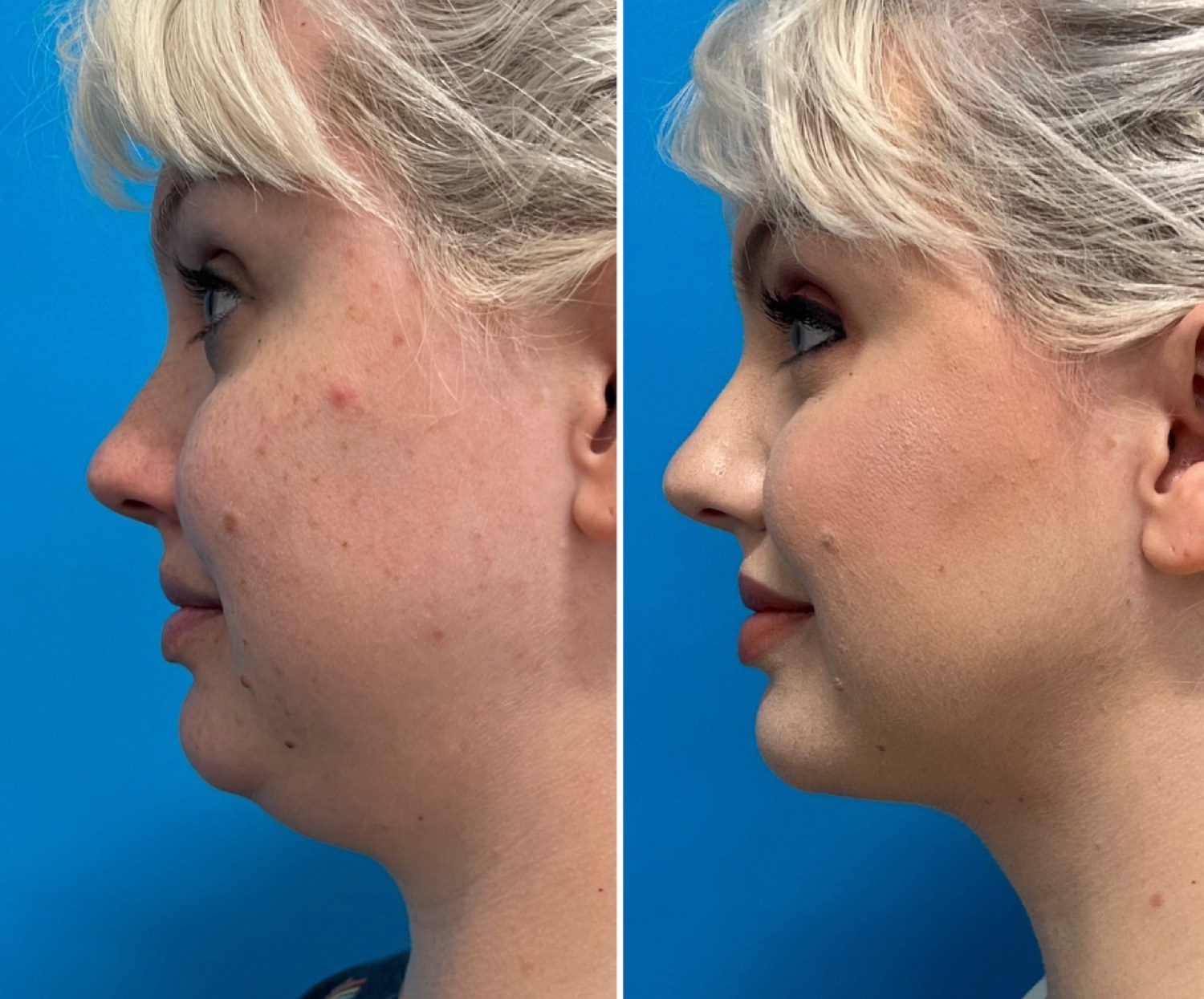 Neck liposuction before and after · before and after composite