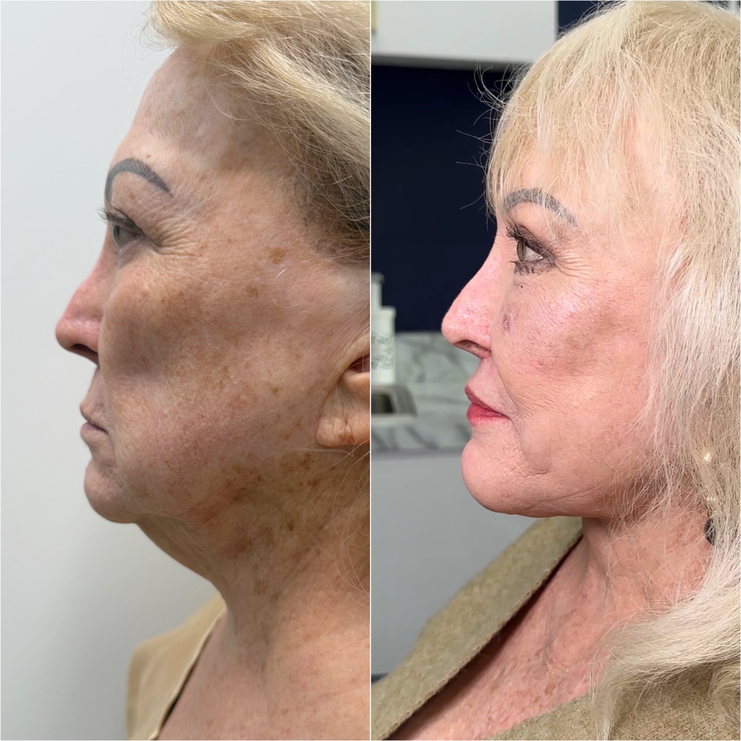 Before and after &mdash; revision facelift and neck lift as part of The Masterpiece, oblique view