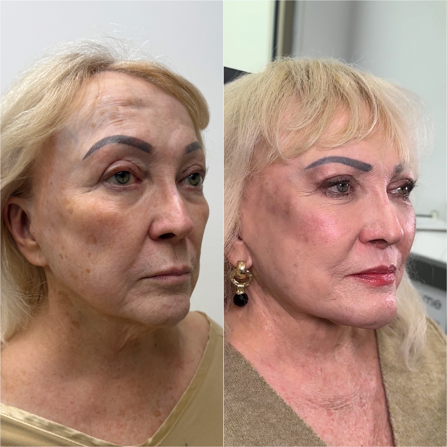Before and after &mdash; revision facelift and neck lift as part of The Masterpiece, profile view