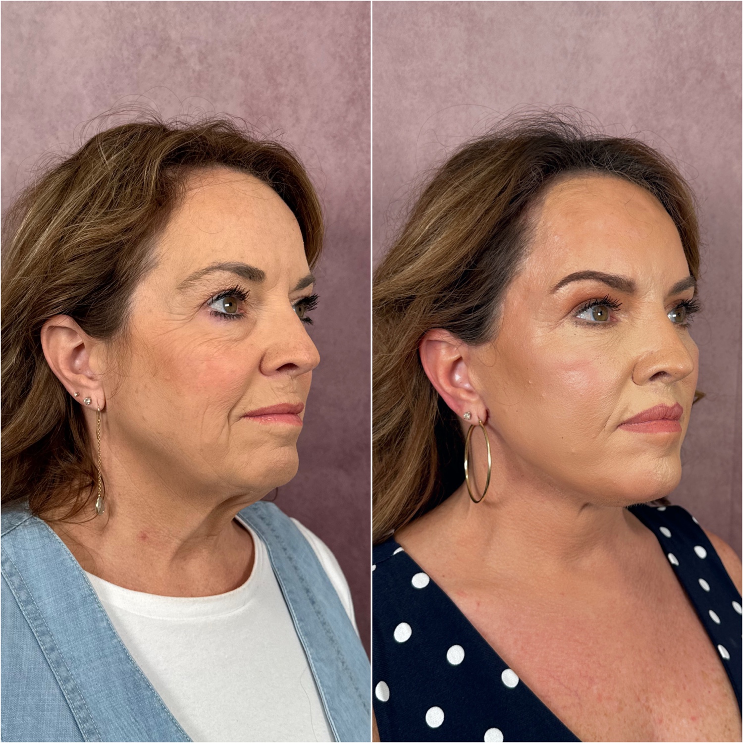 Before and after &mdash; deep neck lift as part of The Masterpiece, oblique view