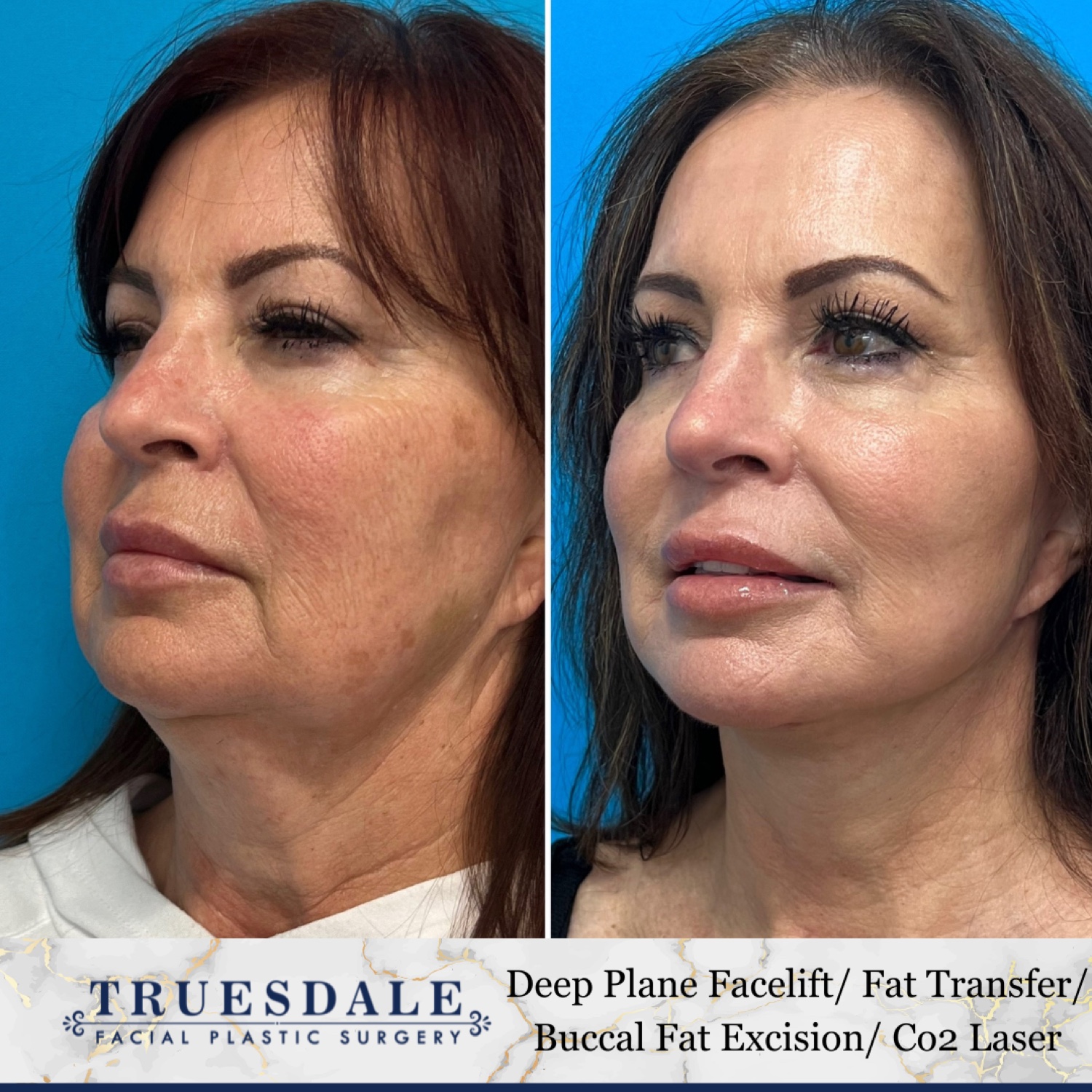Before and after &mdash; deep neck lift as part of The Masterpiece, oblique view