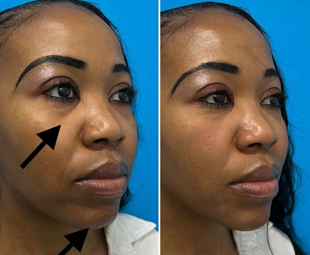Chin, cheek, undereye, and nasolabial filler before and after · before and after composite