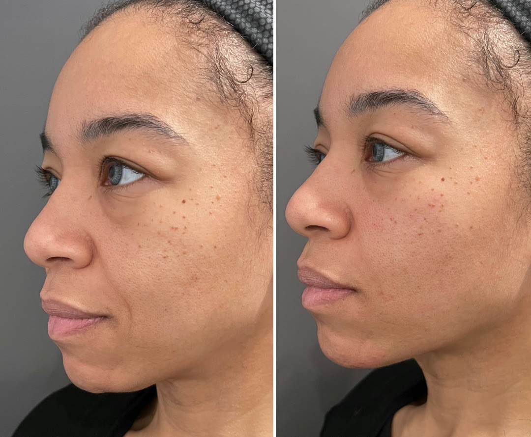 Jaw and chin filler before and after · before and after composite