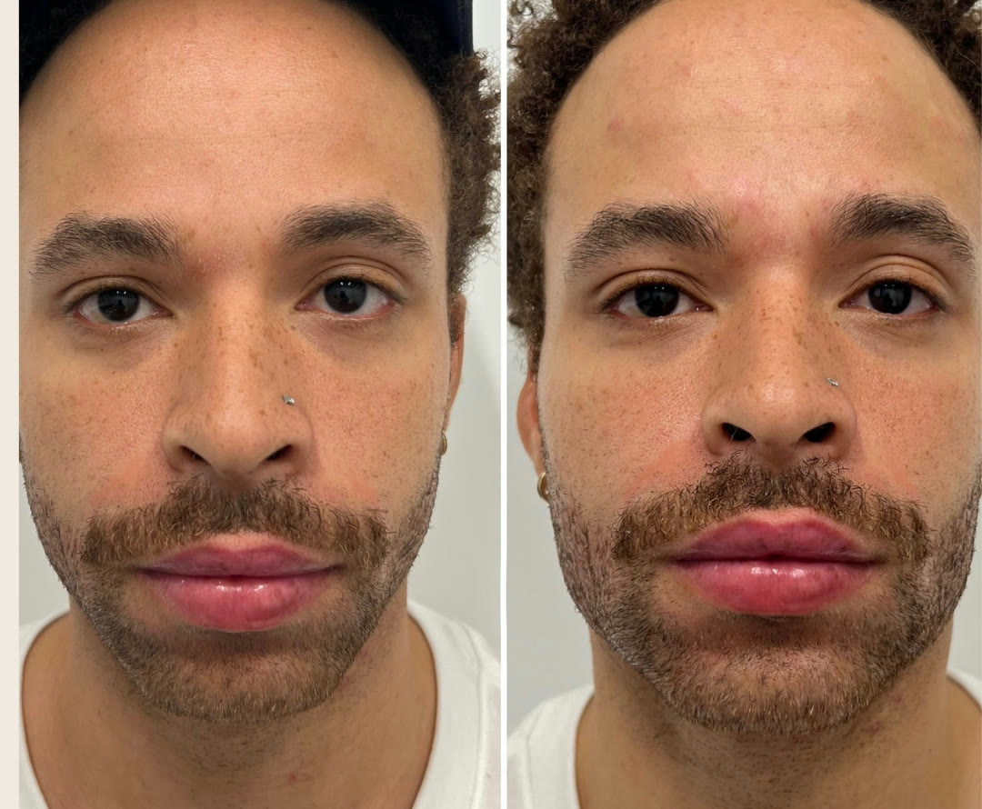 Jawline and chin filler before and after &mdash; male · before and after composite