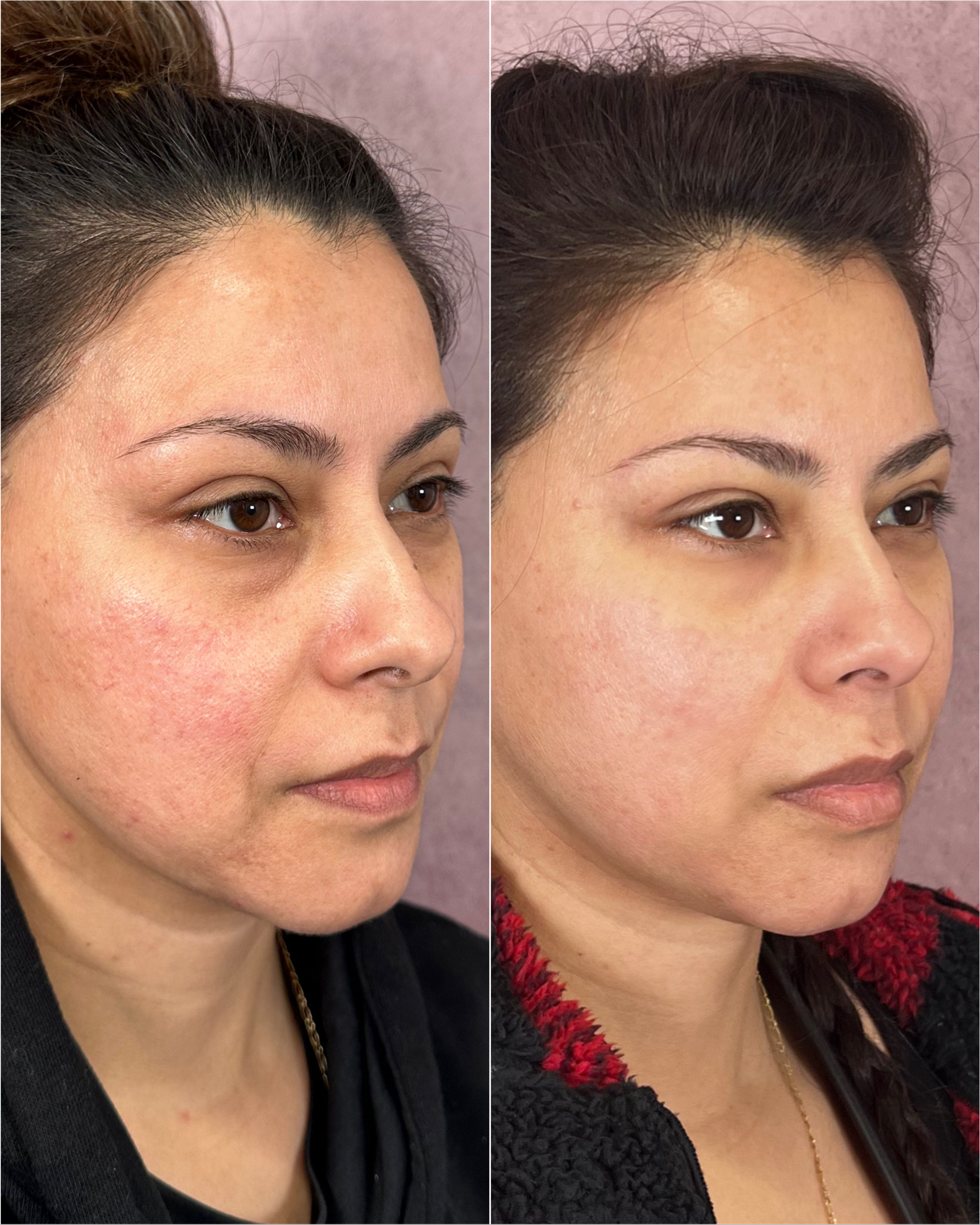 Dermal filler before and after · before and after composite