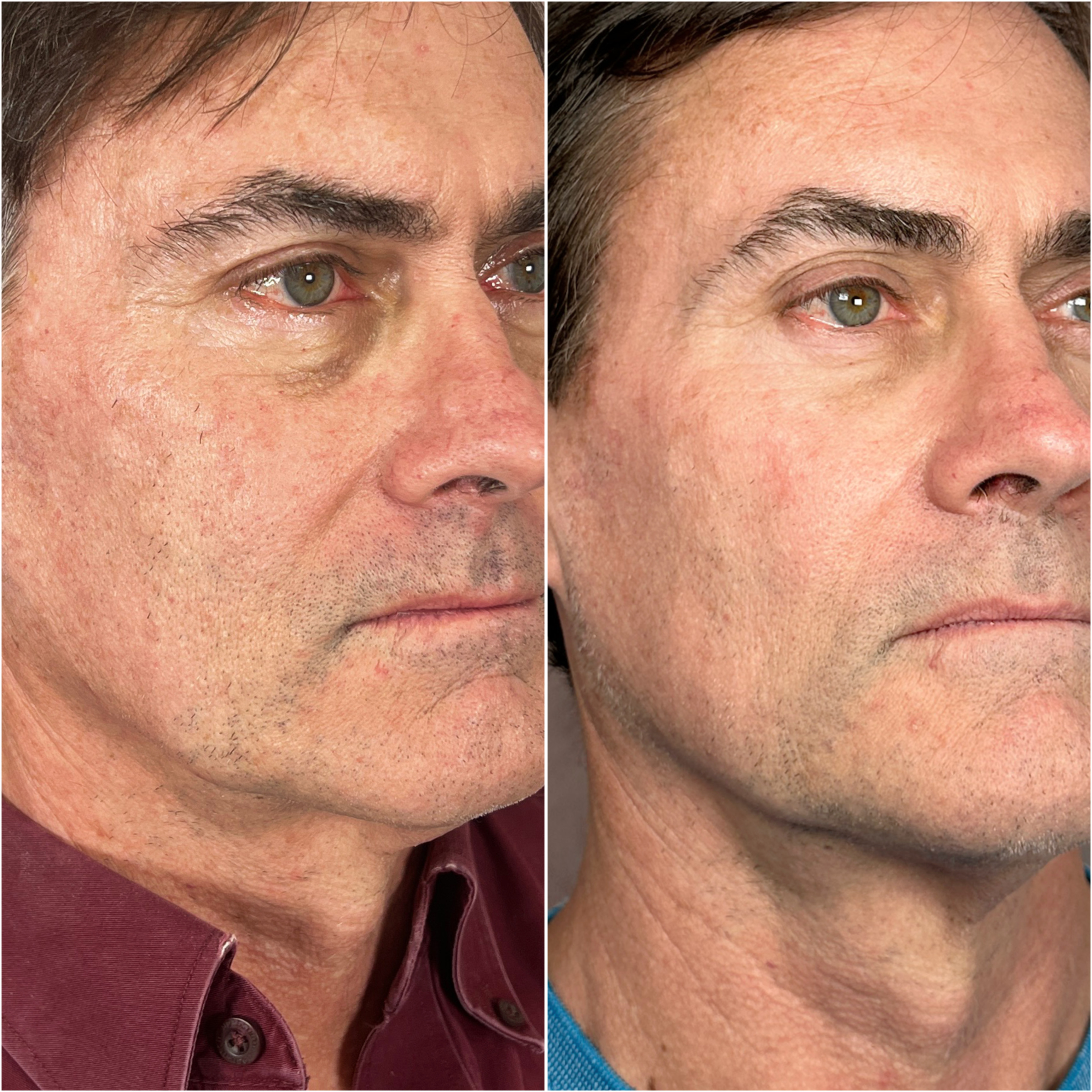 UltraClear laser before and after · before and after composite