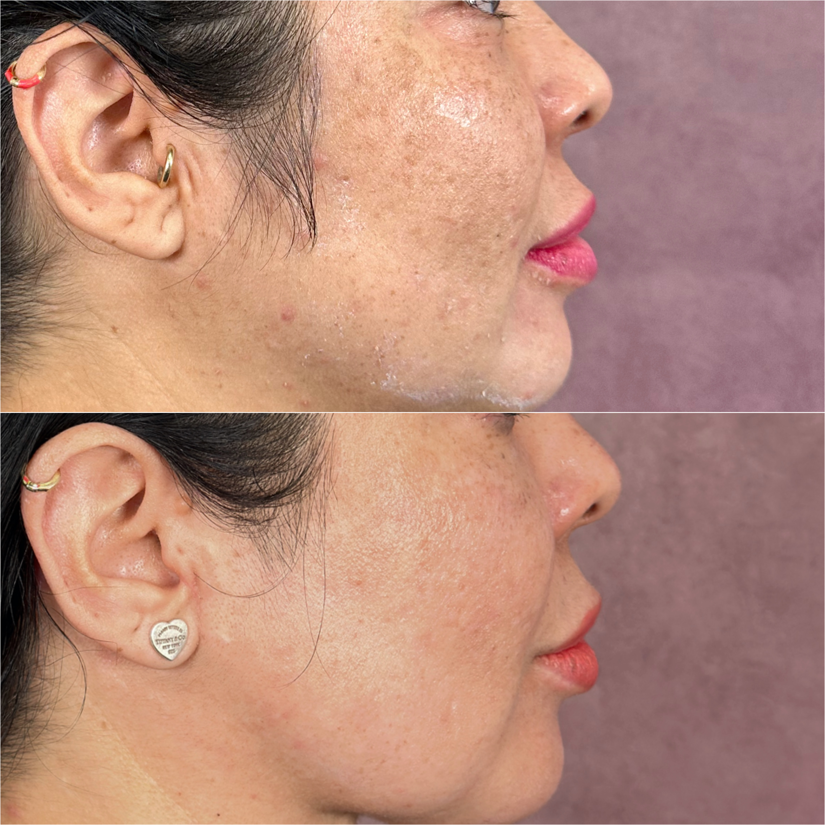 UltraClear laser before and after · before and after composite