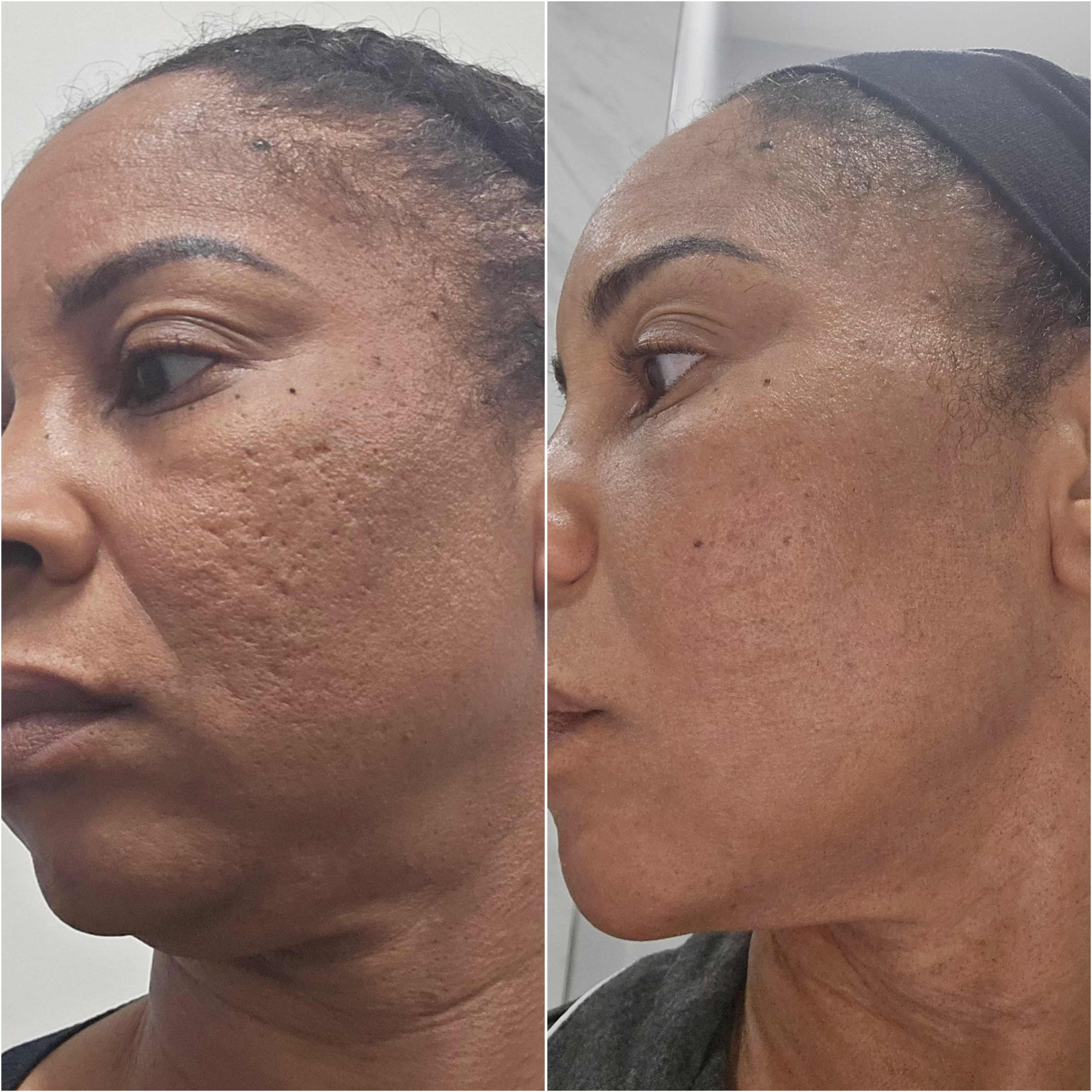 UltraClear laser before and after · before and after composite