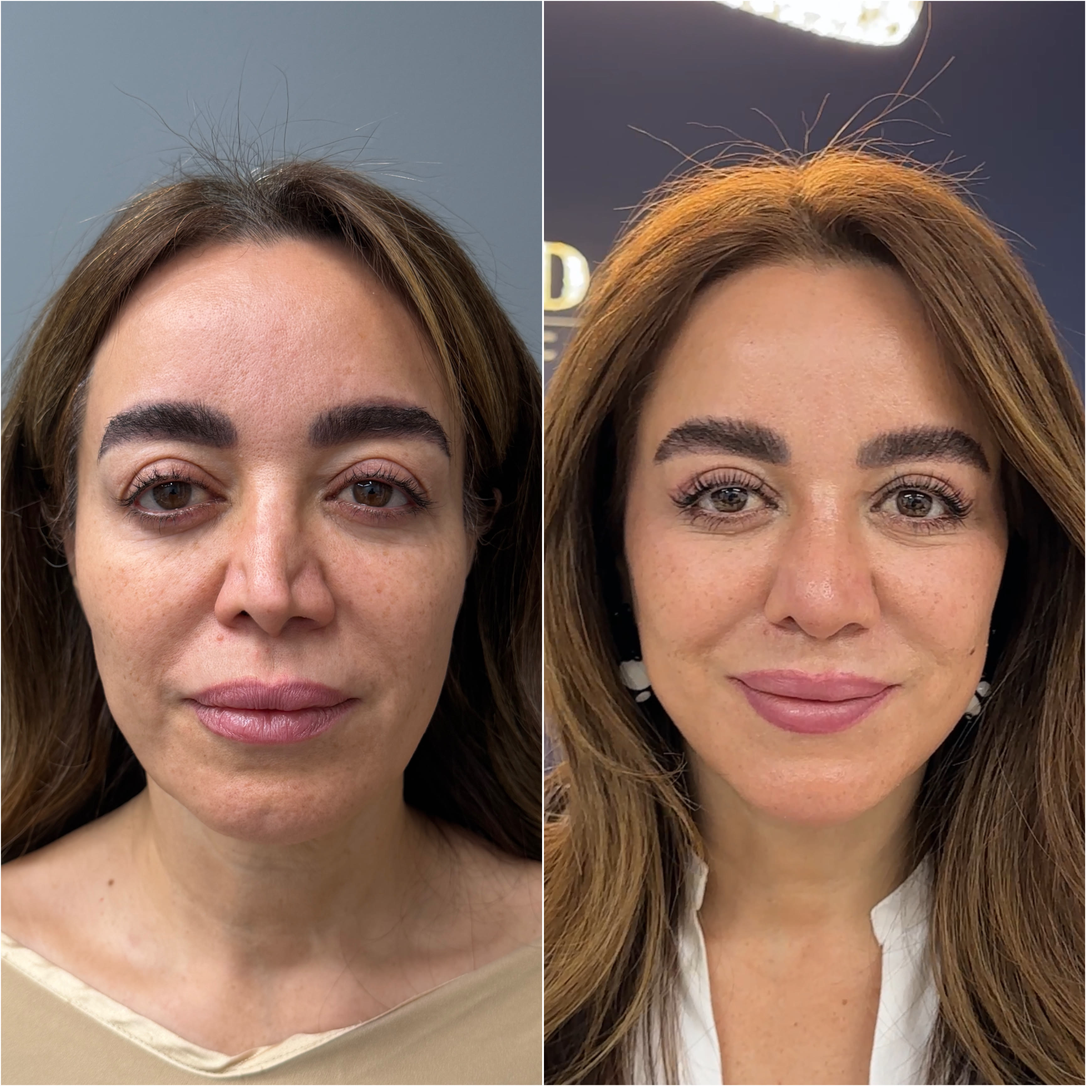 Before and after — rhinoplasty, frontal view