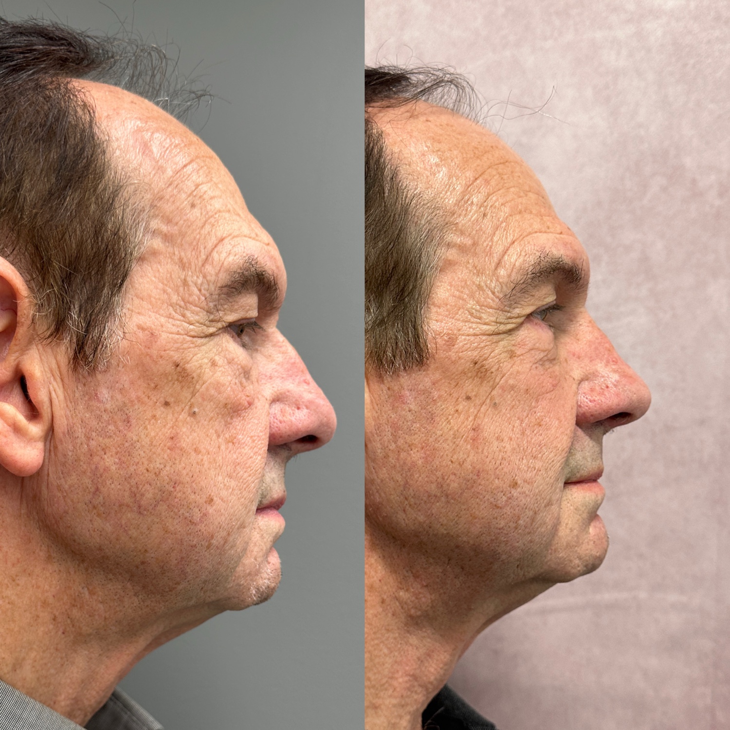 Before and after &mdash; rhinoplasty with facial rejuvenation, right profile view