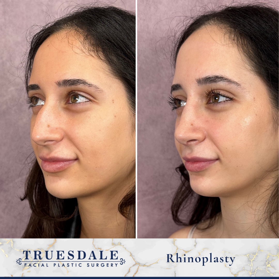 Before and after &mdash; rhinoplasty, oblique view