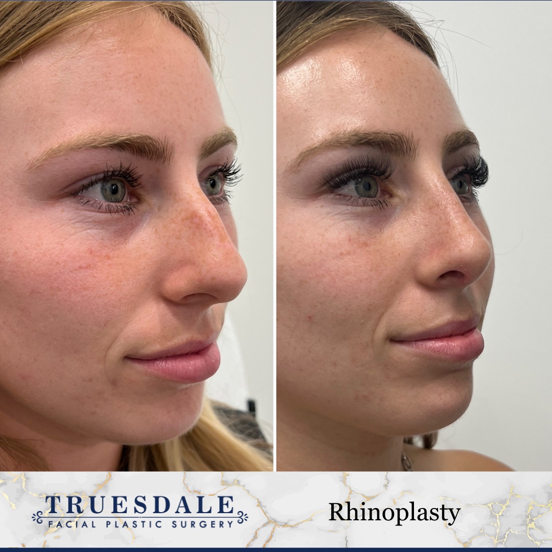 Before and after &mdash; rhinoplasty, oblique view