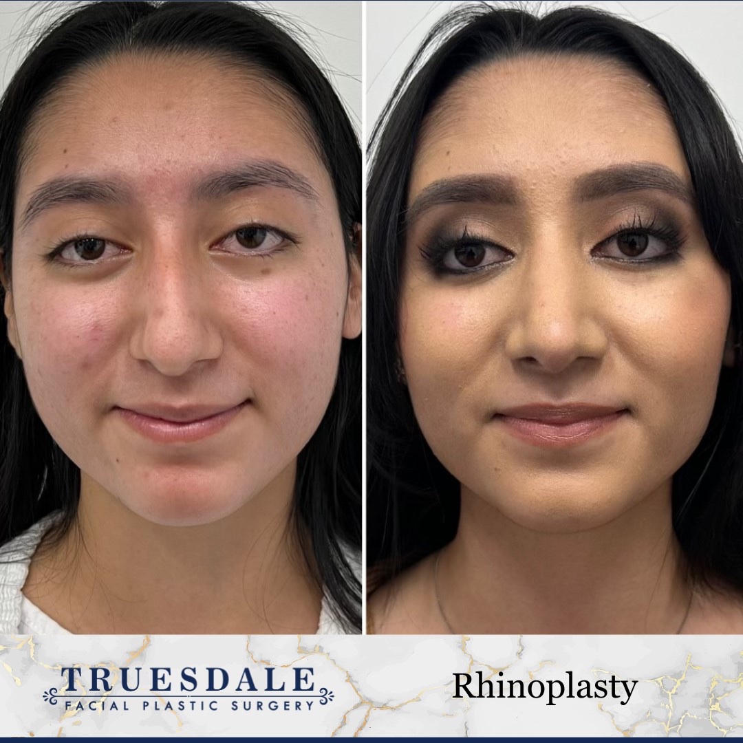 Before and after &mdash; rhinoplasty, frontal view