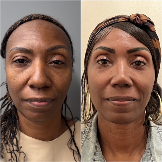 Rhinoplasty before and after · frontal view