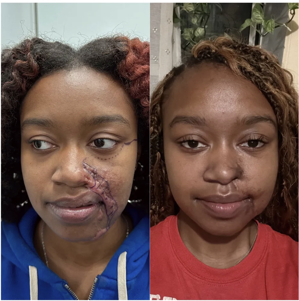 Scar revision before and after &mdash; featured patient · before and after composite