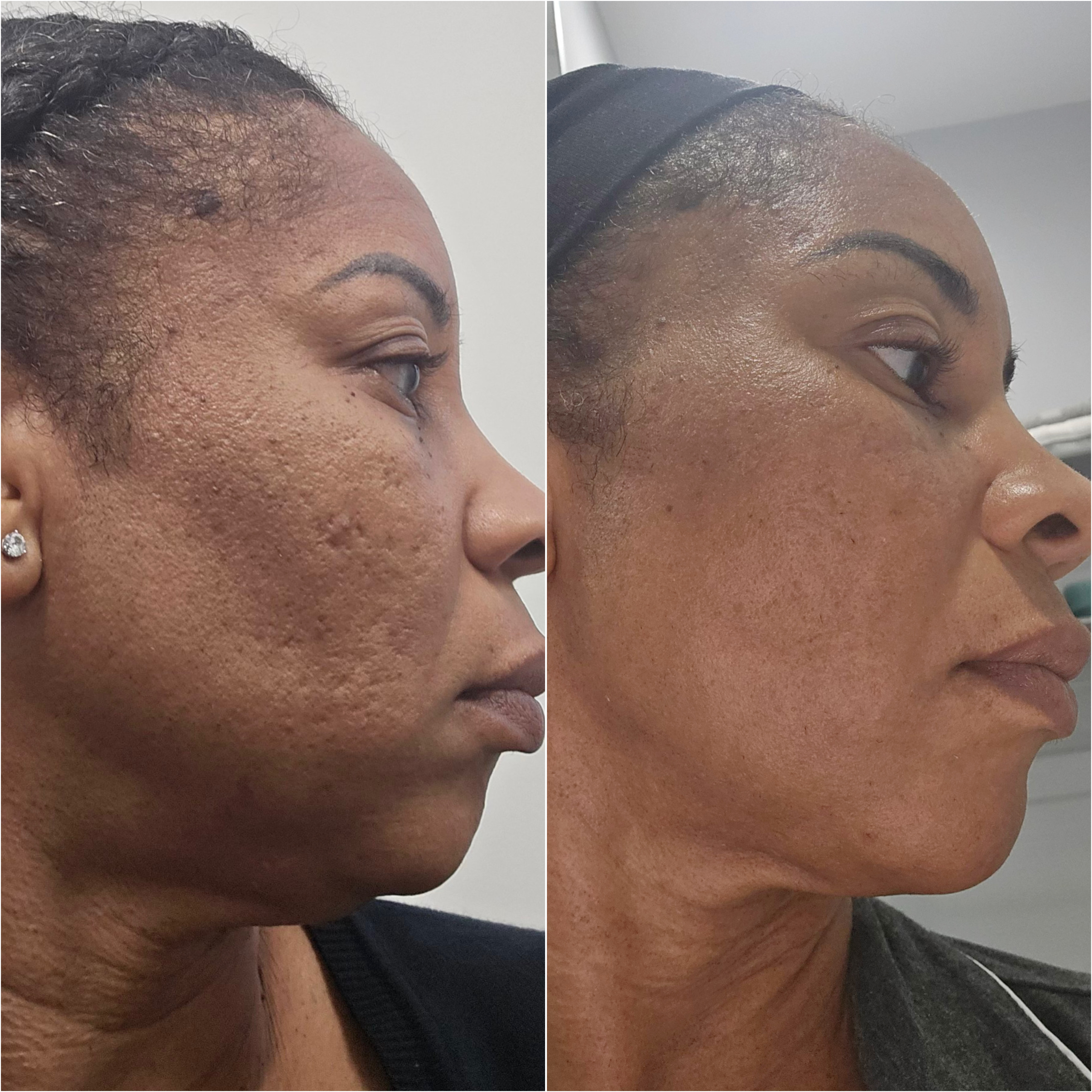 UltraClear laser before and after &mdash; featured patient · before and after composite