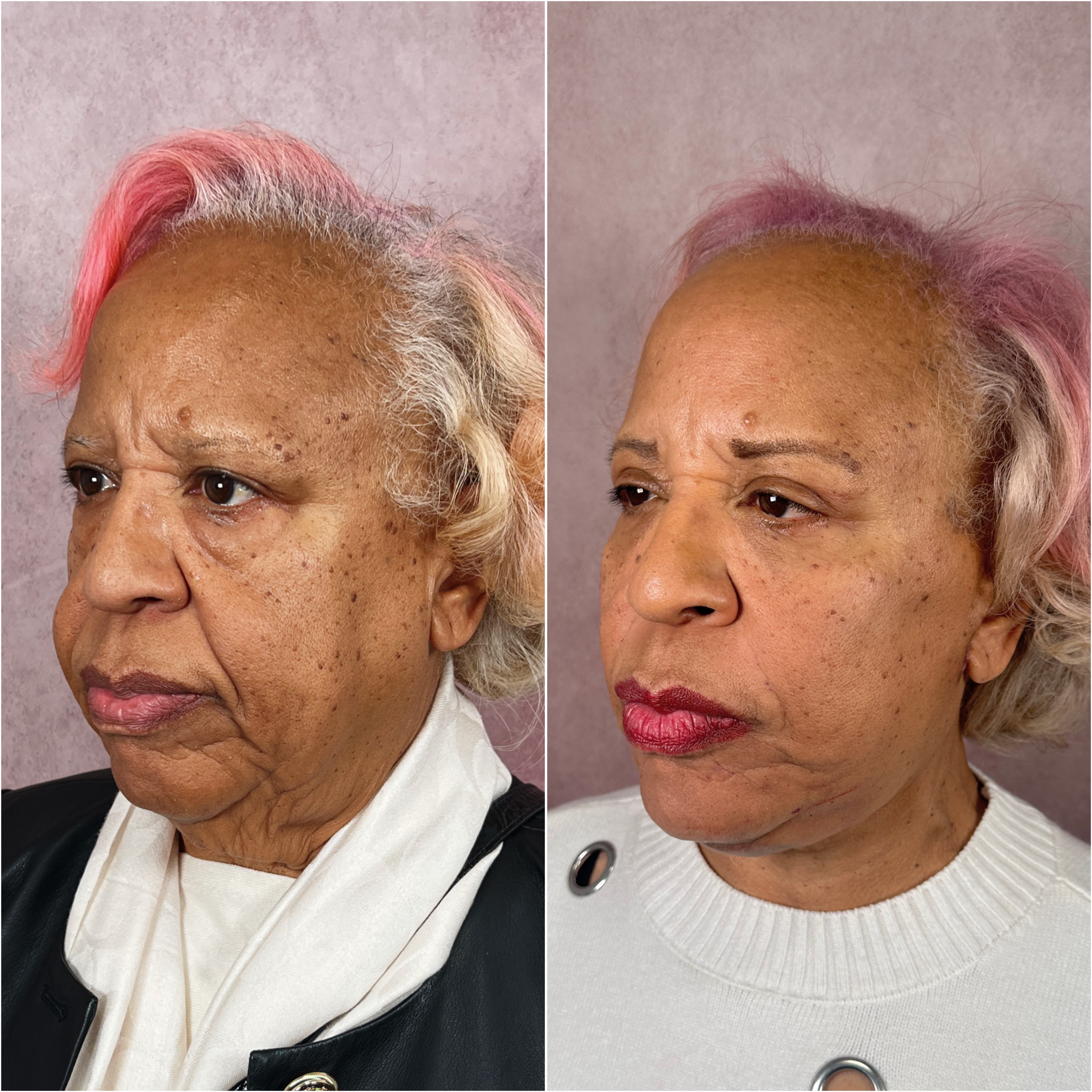 Upper blepharoplasty + other procedures before and after · before and after composite