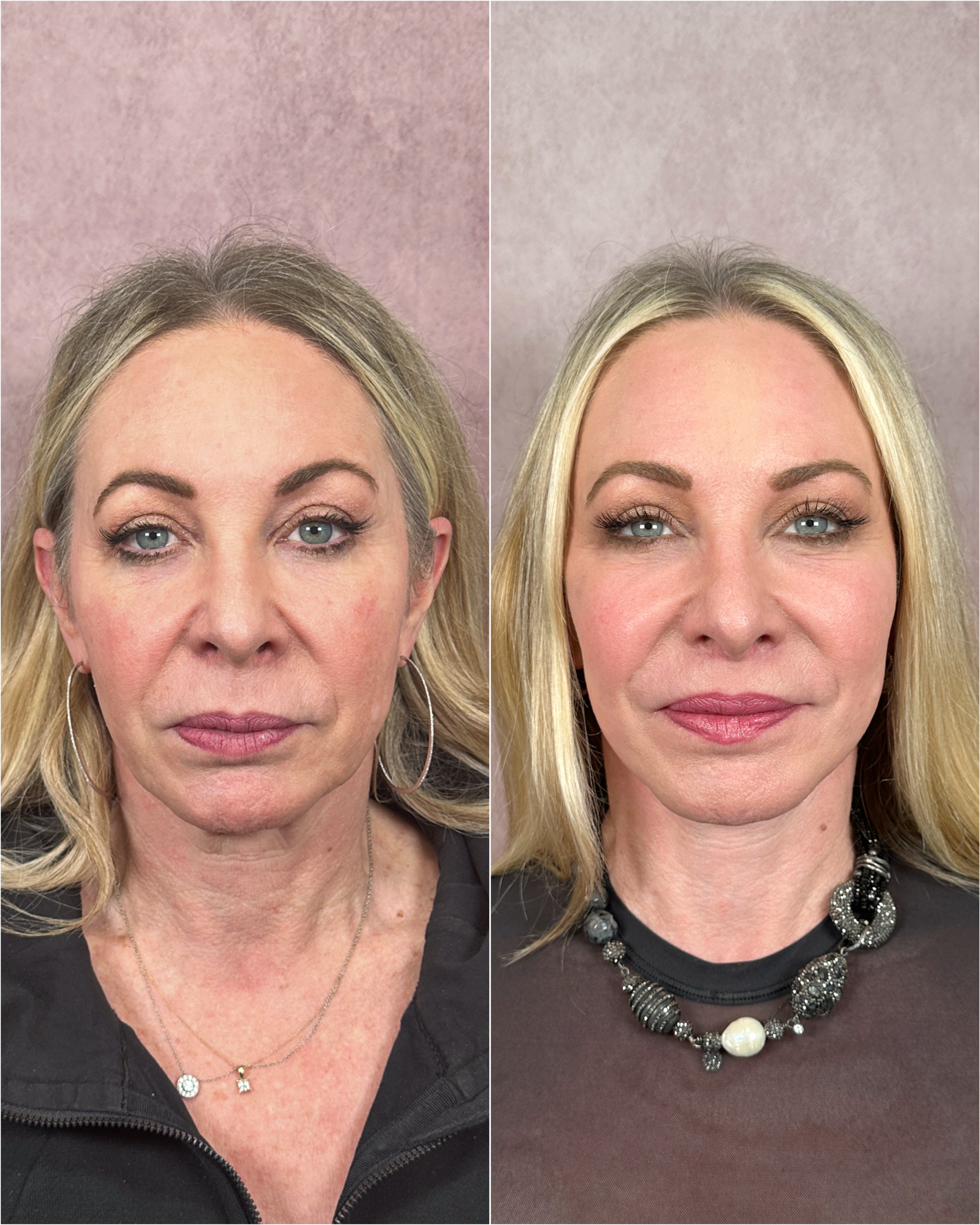 Lip Lift before and after &mdash; fuller upper lip &middot; restored vermillion