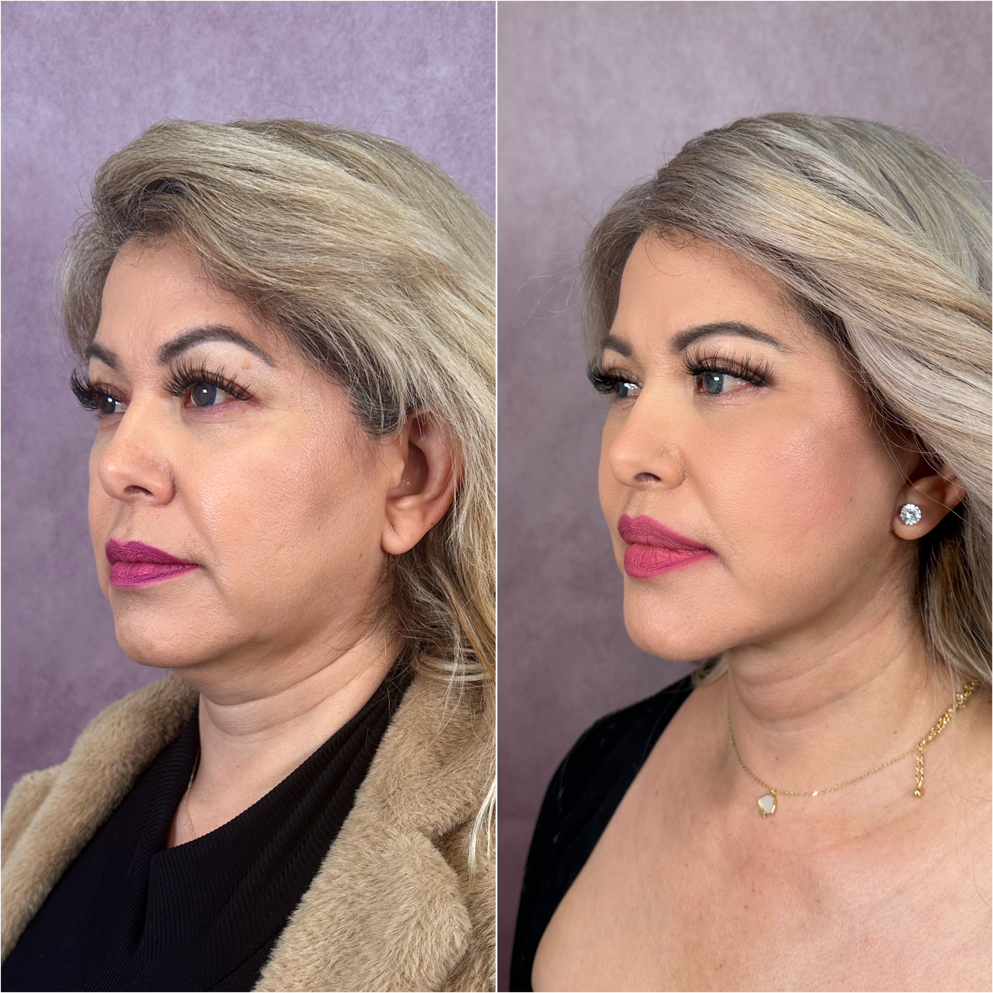 Lip Lift before and after &mdash; more upper-lip show &middot; three-quarter view