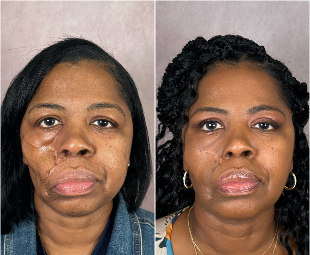 Scar Revision before and after &mdash; facial scar softening
